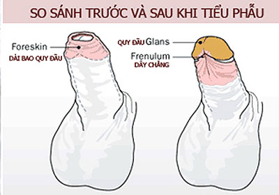 Một số trường hợp để chữa yếu sinh lý cần can thiệp của dao kéo