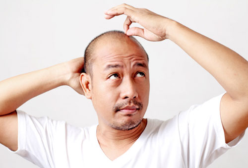 Hói đầu cũng là dấu hiệu nhận biết chàng bị yếu sinh lý