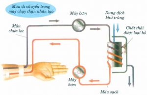 Phương pháp chạy thận nhân tạo là một trong những phương pháp điều trị suy thận cấp hiệu quả hiện nay