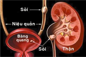 Sỏi thận cũng là nguyên nhân gây thận yếu