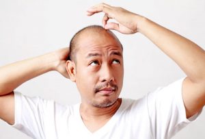 Hói đầu có phải là dấu hiệu nhận biết đàn ông bị yếu sinh lý?