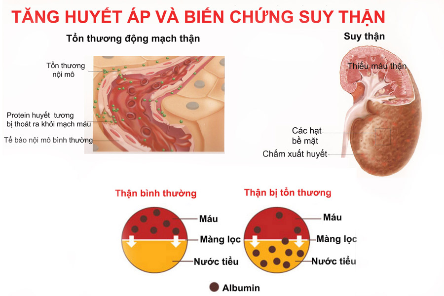 Bệnh cao huyết áp là nguyên nhân gây bệnh suy thận thường gặp