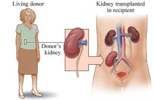 Ghép thận là cách điều trị suy thận mạn giai đoạn cối tối ưu hiện nay