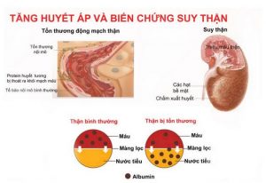 Triệu chứng suy thận độ 3 rõ ràng và thường kèm theo các biến chứng